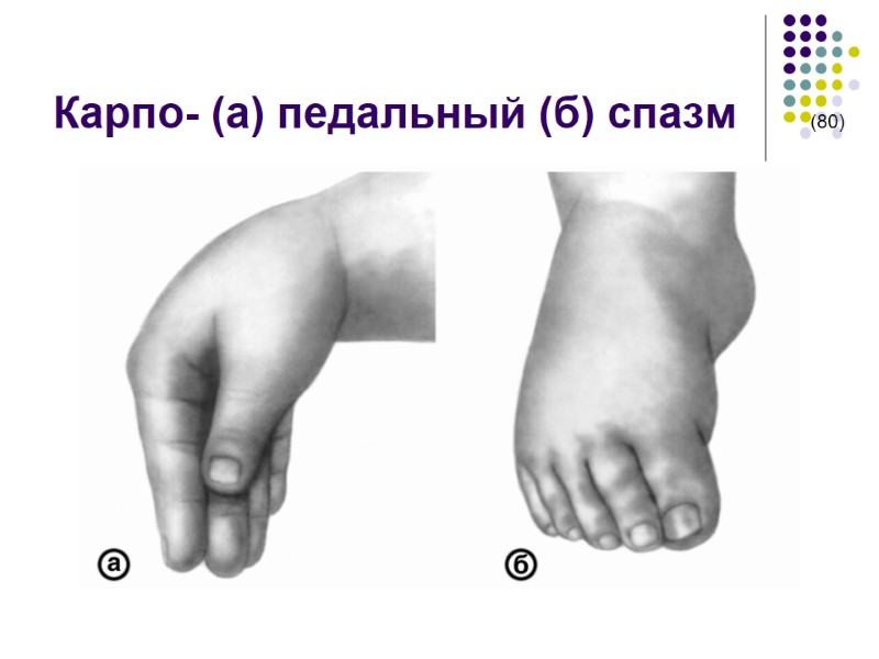 Карпо- (а) педальный (б) спазм      (80)